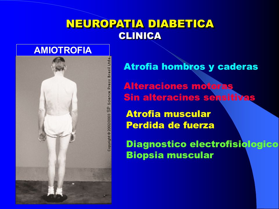 amiotrofia diabetica